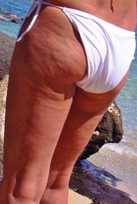 Cellulite