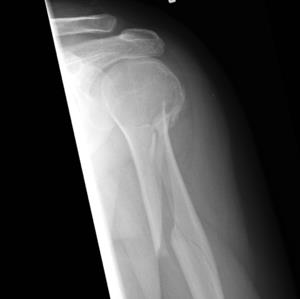 Fractura espiroidea