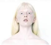 El albinismo